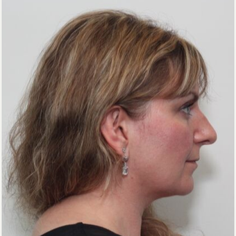 35-44 year old woman treated with Rhinoplasty before 3055193