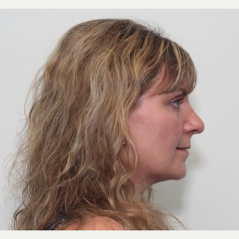 35-44 year old woman treated with Rhinoplasty after 3055193