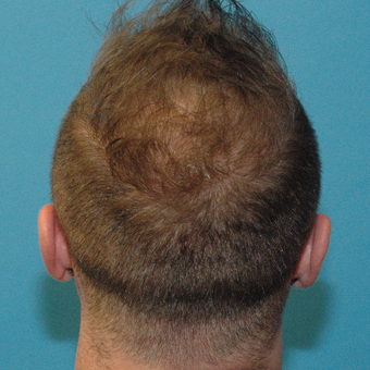 35 year old man treated with Neograft FUE Hair Transplant after 3094572