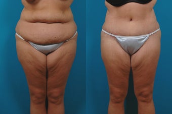 36-year-old woman treated with Lower Body Lift. before 3265057