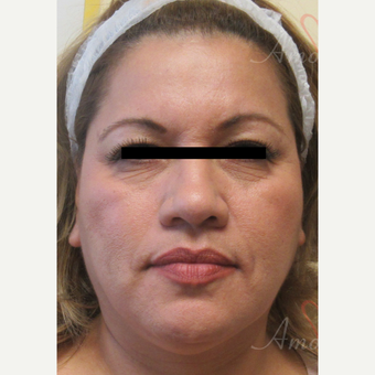 45-54 year old woman treated with Voluma before 3608002