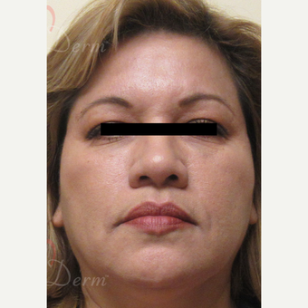 45-54 year old woman treated with Voluma after 3608002