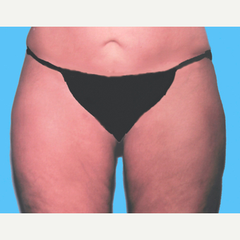 Liposuction after 3810605