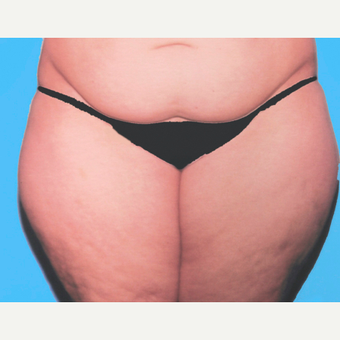 Liposuction before 3810605