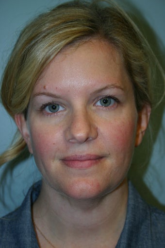 38 year old Female after 934402