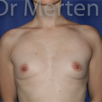 25-34 year old woman treated with Breast Augmentation before 3551651