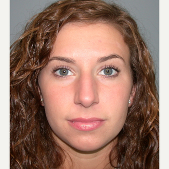 18-24 year old woman treated with Rhinoplasty before 3692274