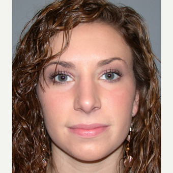 18-24 year old woman treated with Rhinoplasty after 3692274