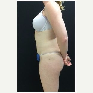 25-34 year old woman treated with Liposuction to Abdomen & Thighs after 3200812