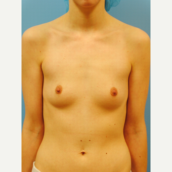 25-34 year old woman treated with Breast Augmentation before 2990168