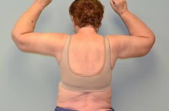 massive excess arm skin 1473524
