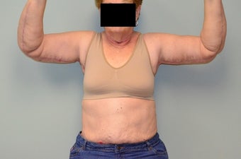massive excess arm skin after 1473524