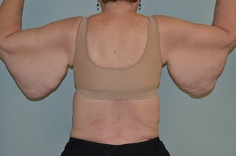 massive excess arm skin 1473524