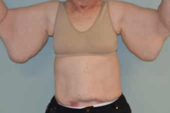 massive excess arm skin before 1473524