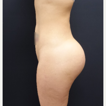 25-34 year old woman treated with 712cc Round Silicone Butt Implants after 3259556