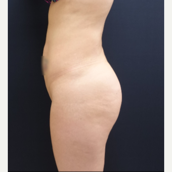 25-34 year old woman treated with 712cc Round Silicone Butt Implants before 3259556