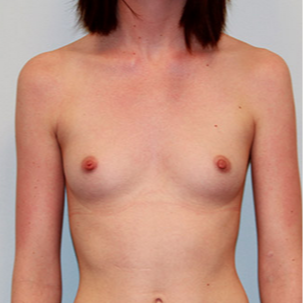 Breast Augmentation before 2130310
