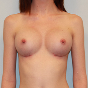 Breast Augmentation after 2130310
