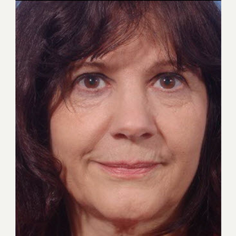 55-64 year old woman treated with ArteFill after 3711593