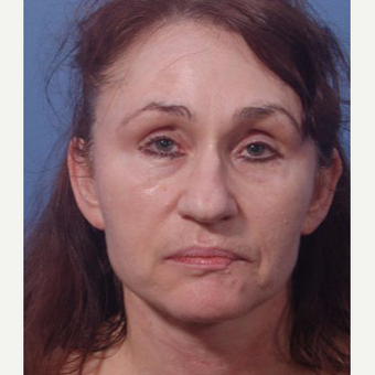 55-64 year old woman treated with Bellafill/ArteFill before 3749445