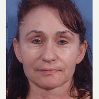 55-64 year old woman treated with Bellafill/ArteFill after 3749445