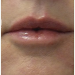 45-54 year old woman treated with Volbella after 3685161