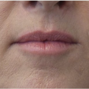 45-54 year old woman treated with Volbella before 3685161