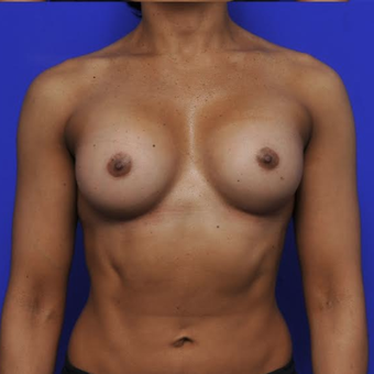 41 year old woman treated with Breast Augmentation after 3840334