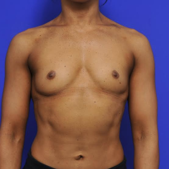 41 year old woman treated with Breast Augmentation before 3840334