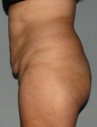 10 weeks after liposuction and SlimLipo laser after 1079348