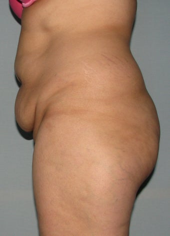 10 weeks after liposuction and SlimLipo laser before 1079348