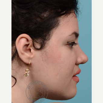 18-24 year old woman treated with open Rhinoplasty and base of nose narrowing after 3092688