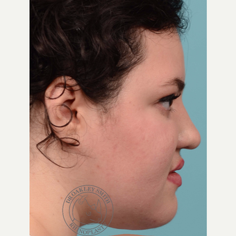 18-24 year old woman treated with open Rhinoplasty and base of nose narrowing before 3092688