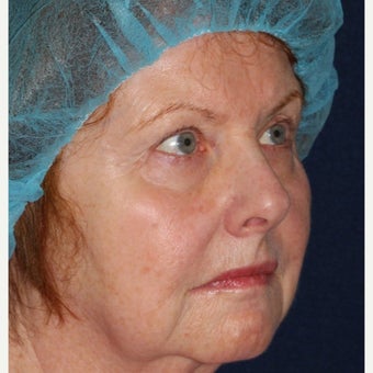 69 year old woman treated by Dr. Groff with Photofacial technique after 1645549