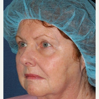 69 year old woman treated by Dr. Groff with Photofacial technique 1645549