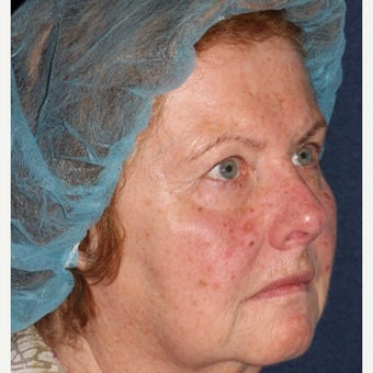 69 year old woman treated by Dr. Groff with Photofacial technique before 1645549