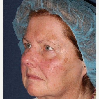 69 year old woman treated by Dr. Groff with Photofacial technique 1645549