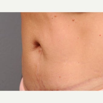 Belly Button Surgery 1701127