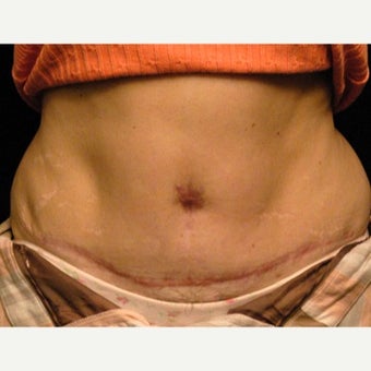 Belly Button Surgery before 1701127