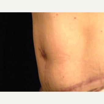 Belly Button Surgery 1701127