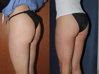 Before & After Ultherapy before 678465