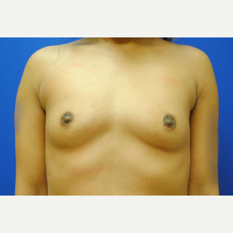 25-34 year old woman treated with Breast Augmentation before 3299825