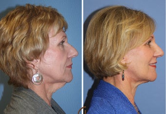 Natural Looking Lower Face Lift with Fat Grafting 418253