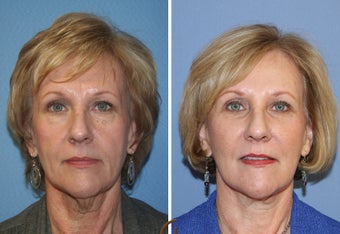 Natural Looking Lower Face Lift with Fat Grafting before 418253