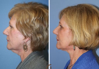Natural Looking Lower Face Lift with Fat Grafting after 418253
