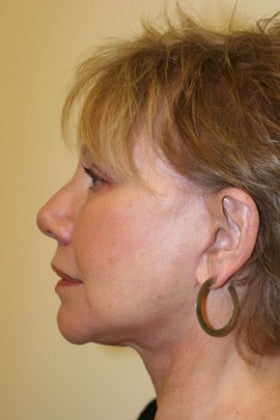 Cheek Augmentation after 1622489