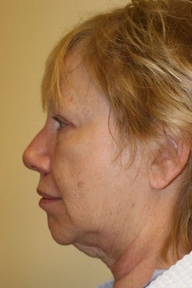 Cheek Augmentation before 1622489