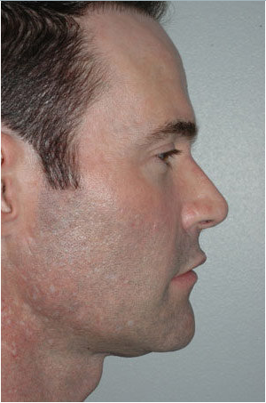 Revision Rhinoplasty after 229628