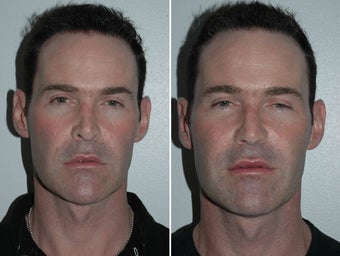 Revision Rhinoplasty 229628