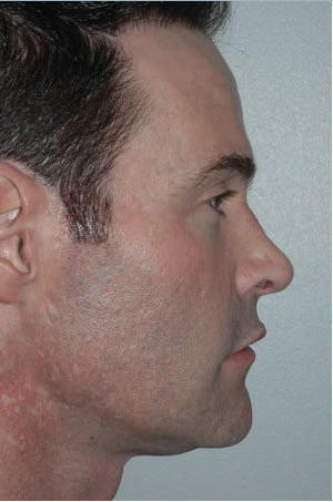 Revision Rhinoplasty before 229628